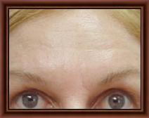 botulinum toxin After